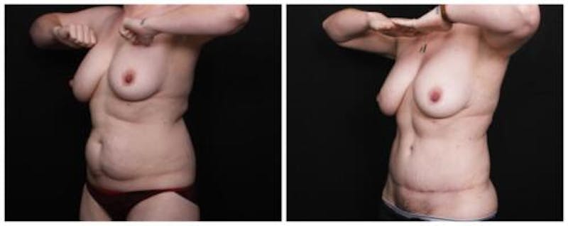 Abdominoplasty Before & After Gallery - Patient 256096 - Image 3