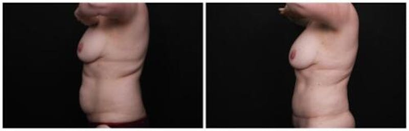 Abdominoplasty Before & After Gallery - Patient 256096 - Image 4
