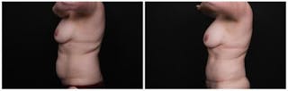Abdominoplasty Before & After Gallery - Patient 256096 - Image 4