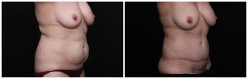 Abdominoplasty Before & After Gallery - Patient 256096 - Image 5