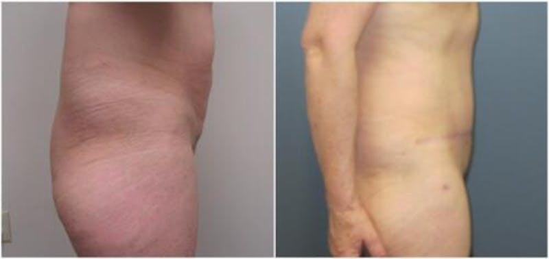 Abdominoplasty Before & After Gallery - Patient 641850 - Image 1