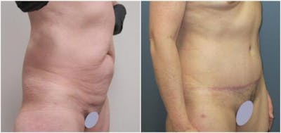Abdominoplasty Before & After Gallery - Patient 641850 - Image 2