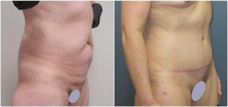 Abdominoplasty Before & After Gallery - Patient 641850 - Image 2