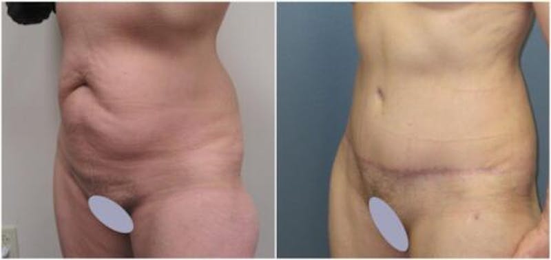 Abdominoplasty Before & After Gallery - Patient 641850 - Image 3