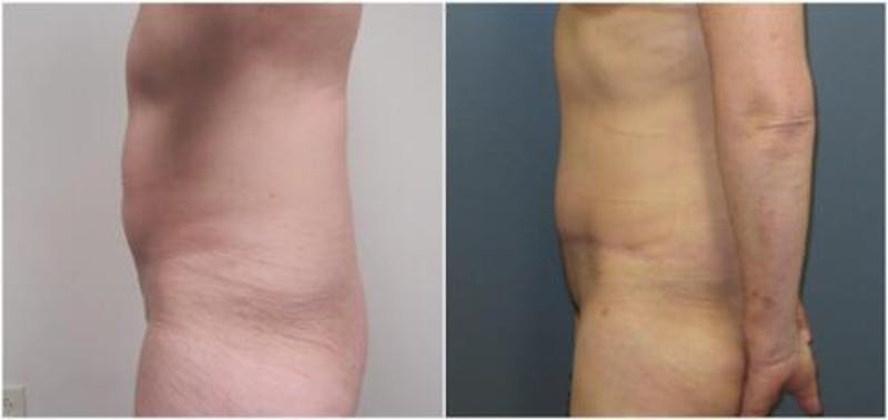 Abdominoplasty Before & After Gallery - Patient 641850 - Image 4