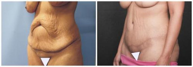 Abdominoplasty Before & After Gallery - Patient 330912 - Image 1