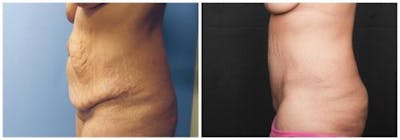 Abdominoplasty Before & After Gallery - Patient 330912 - Image 2