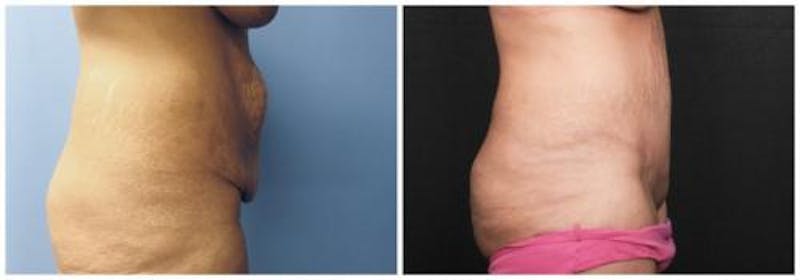 Abdominoplasty Before & After Gallery - Patient 330912 - Image 3