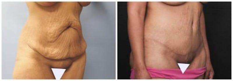 Abdominoplasty Before & After Gallery - Patient 330912 - Image 4