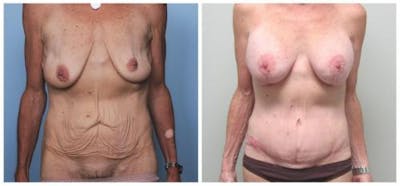 Abdominoplasty Before & After Gallery - Patient 286604 - Image 1