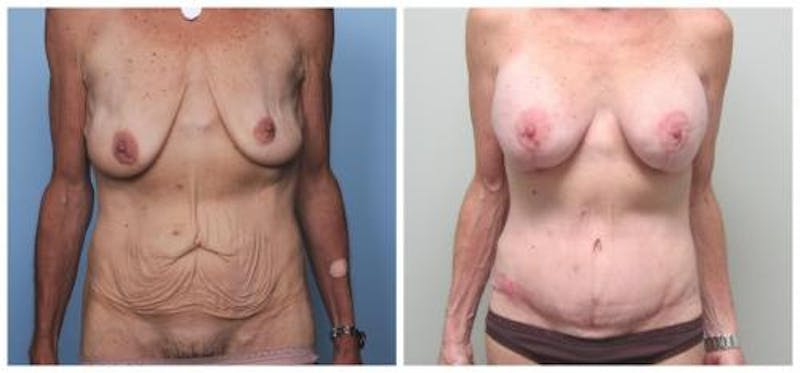 Abdominoplasty Before & After Gallery - Patient 286604 - Image 1