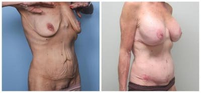 Abdominoplasty Before & After Gallery - Patient 286604 - Image 2
