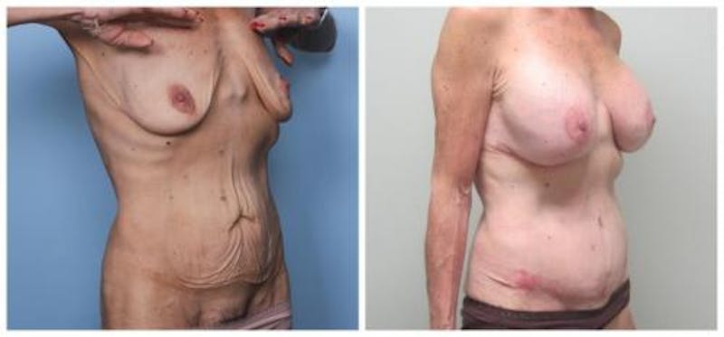 Abdominoplasty Before & After Gallery - Patient 286604 - Image 2