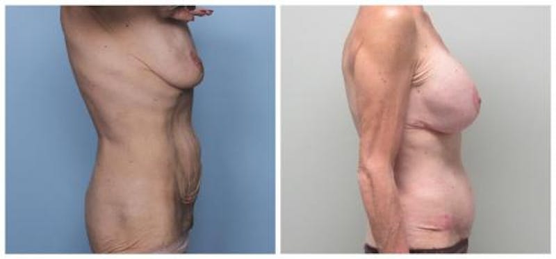 Abdominoplasty Before & After Gallery - Patient 286604 - Image 3