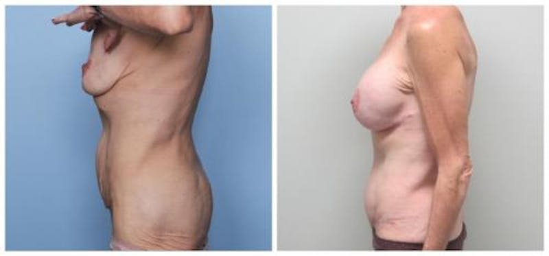 Abdominoplasty Before & After Gallery - Patient 286604 - Image 4