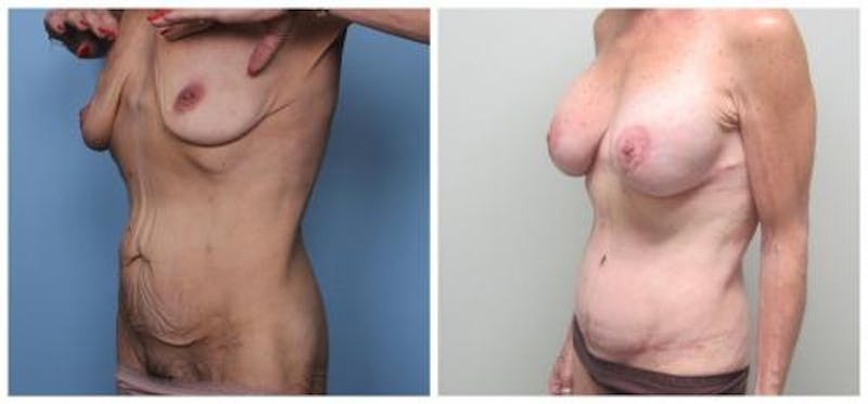Abdominoplasty Before & After Gallery - Patient 286604 - Image 5