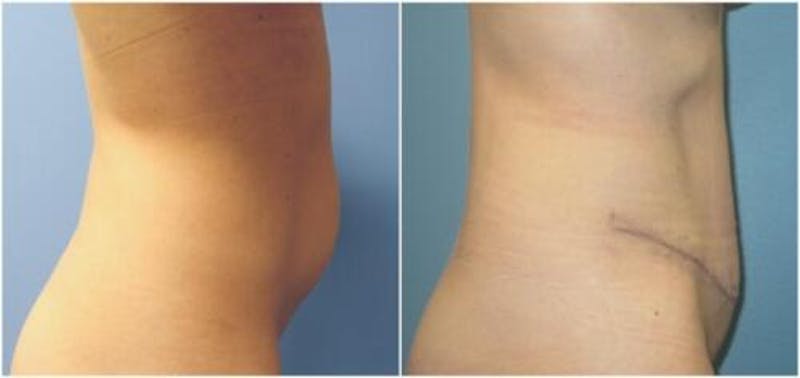 Abdominoplasty Before & After Gallery - Patient 360003 - Image 1
