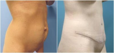 Abdominoplasty Before & After Gallery - Patient 360003 - Image 2
