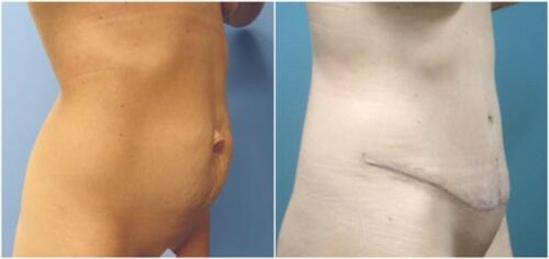 Abdominoplasty Before & After Gallery - Patient 360003 - Image 2