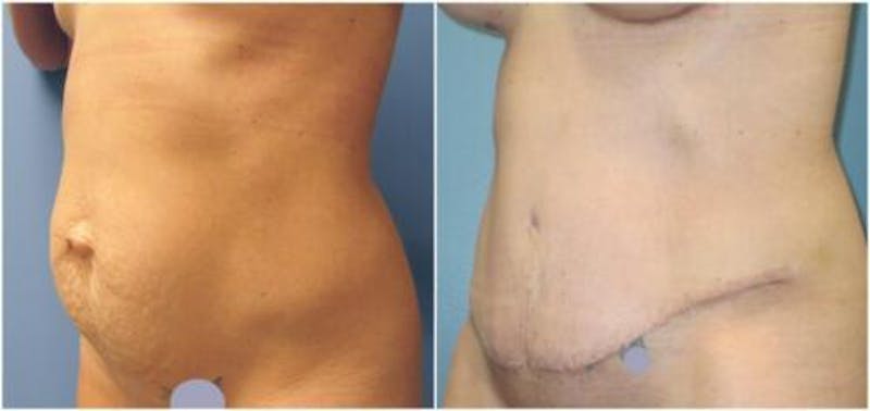 Abdominoplasty Before & After Gallery - Patient 360003 - Image 3