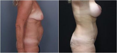 Abdominoplasty Before & After Gallery - Patient 172223 - Image 1