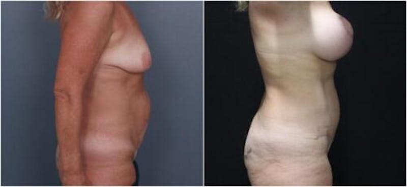 Abdominoplasty Before & After Gallery - Patient 172223 - Image 1