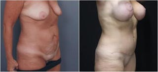 Abdominoplasty Before & After Gallery - Patient 172223 - Image 2