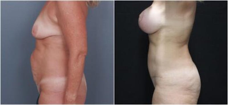 Abdominoplasty Before & After Gallery - Patient 172223 - Image 3