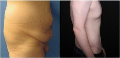 Abdominoplasty Before & After Gallery - Patient 309557 - Image 1