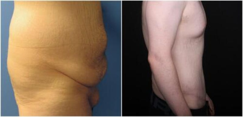 Abdominoplasty Before & After Gallery - Patient 309557 - Image 1