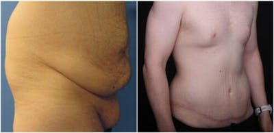 Abdominoplasty Before & After Gallery - Patient 309557 - Image 2