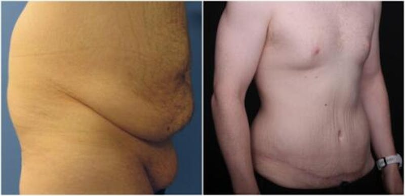 Abdominoplasty Before & After Gallery - Patient 309557 - Image 2