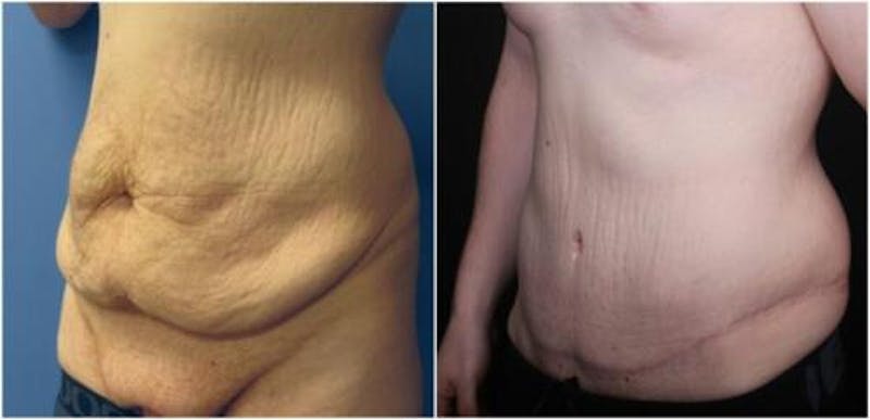 Abdominoplasty Before & After Gallery - Patient 309557 - Image 3