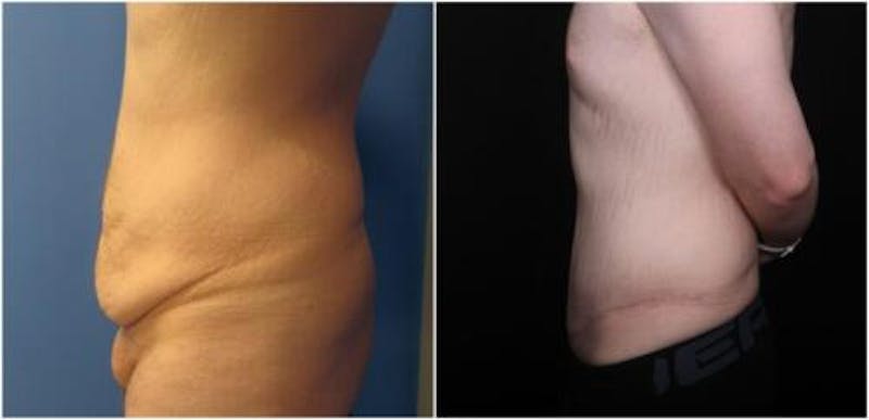 Abdominoplasty Before & After Gallery - Patient 309557 - Image 4