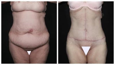 Abdominoplasty Before & After Gallery - Patient 924376 - Image 1