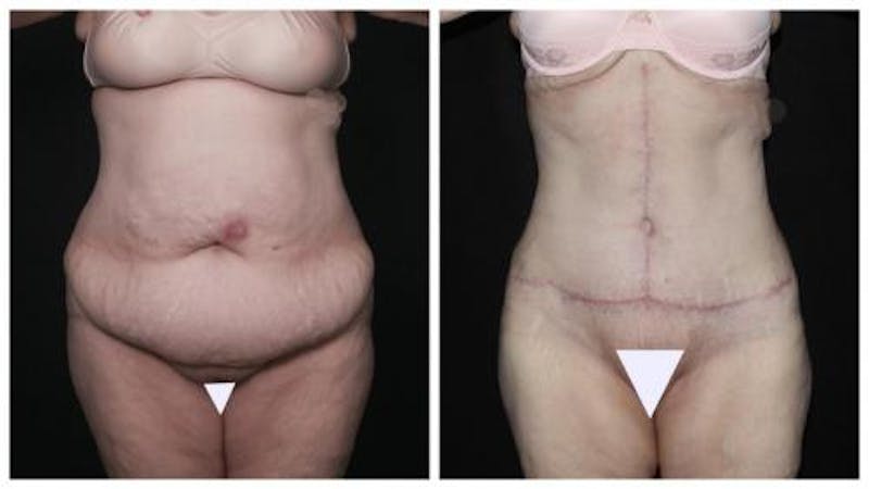 Abdominoplasty Before & After Gallery - Patient 924376 - Image 1