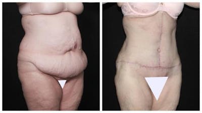 Abdominoplasty Before & After Gallery - Patient 924376 - Image 2