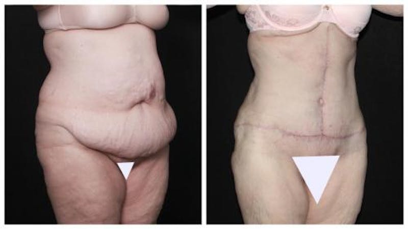 Abdominoplasty Before & After Gallery - Patient 924376 - Image 2