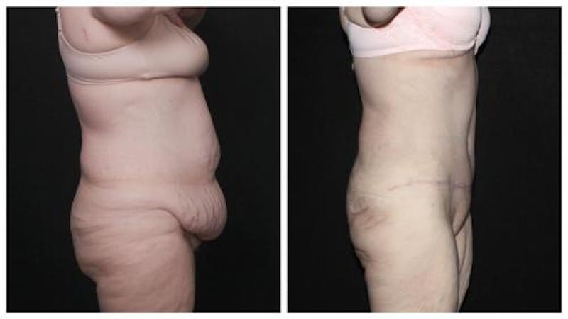 Abdominoplasty Before & After Gallery - Patient 924376 - Image 3