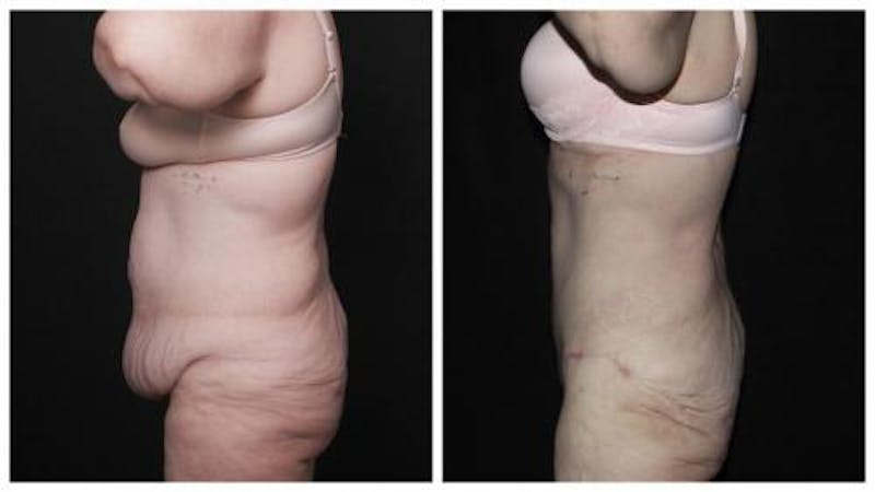 Abdominoplasty Before & After Gallery - Patient 924376 - Image 4