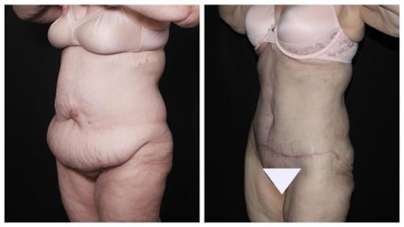 Abdominoplasty Before & After Gallery - Patient 924376 - Image 5