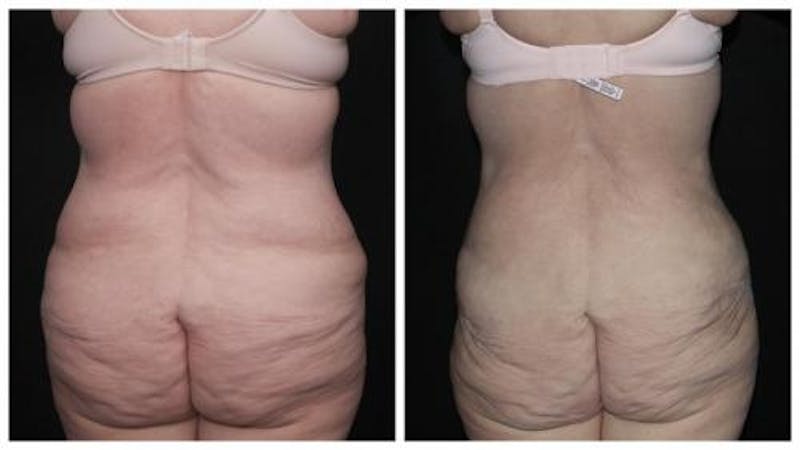 Abdominoplasty Before & After Gallery - Patient 924376 - Image 6