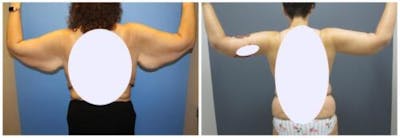 Brachioplasty Before & After Gallery - Patient 222448 - Image 1