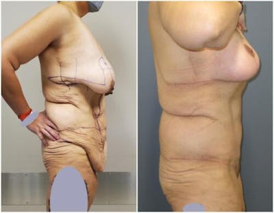 Abdominoplasty Before & After Gallery - Patient 301179 - Image 1