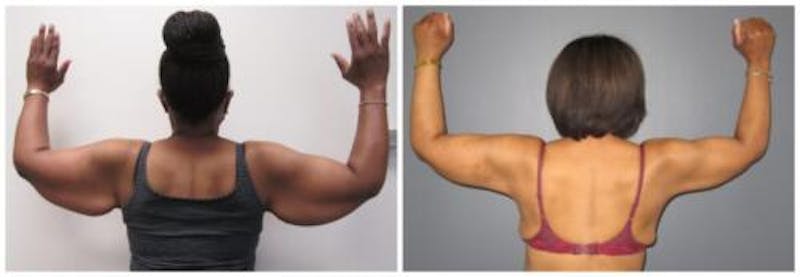 Brachioplasty Before & After Gallery - Patient 165685 - Image 1