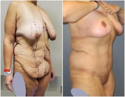 Abdominoplasty Before & After Gallery - Patient 301179 - Image 2