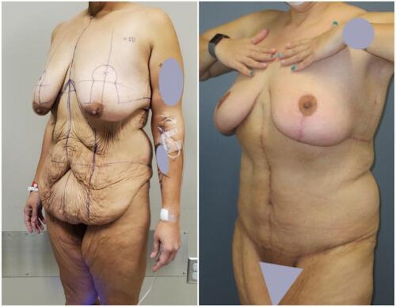Abdominoplasty Before & After Gallery - Patient 301179 - Image 3