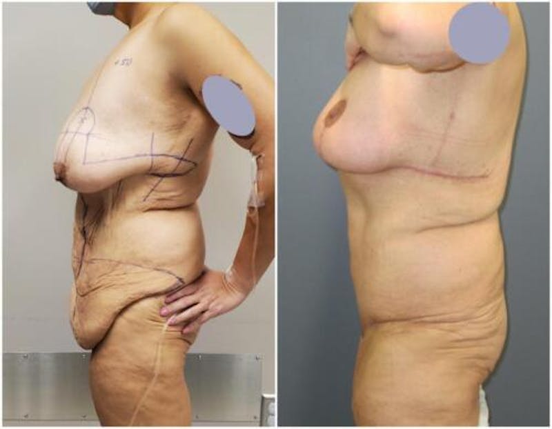 Abdominoplasty Before & After Gallery - Patient 301179 - Image 4