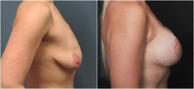 Breast Augmentation Before & After Gallery - Patient 113480 - Image 1