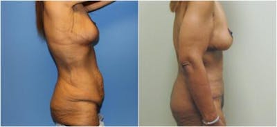 Abdominoplasty Before & After Gallery - Patient 269378 - Image 1